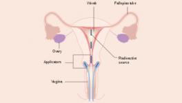 Cervical Cancer